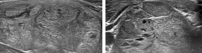 Diagnosis of Thyroid Nodules from Medical Ultrasound Images with Deep Learning
